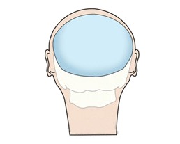 뒤통수성형 후 뒷모습 두개골 그림(본시멘트 삽입 부위 하늘색)