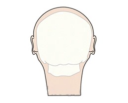 뒤통수성형 전 뒷모습 두개골 그림