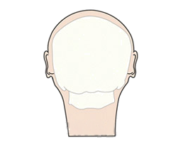 뒤통수성형 전 뒷모습 두개골 그림