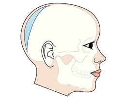 뒤통수성형 후 옆모습 두개골 그림(본시멘트 삽입 부위 하늘색)